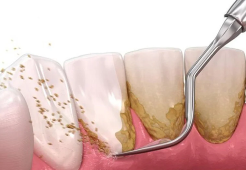 Lấy Cao Răng Là Gì? Lợi Ích Của Việc Lấy Cao Răng Bạn Cần Biết